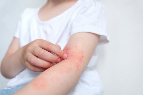研究调查了新生儿维生素D对成年期湿疹的潜在影响