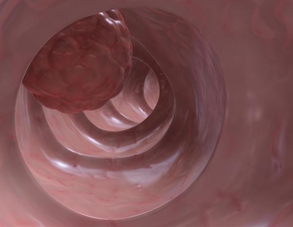 科学家发现一种基因是结肠癌转移的有力预测因子