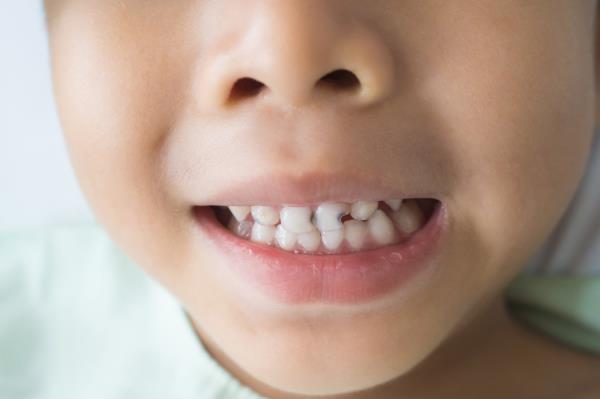 儿童血清维生素D水平与龋齿或臼齿低矿化有关吗?