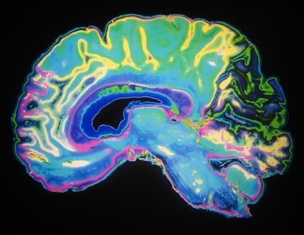 新的大脑连接图提供了对人类意识的洞察