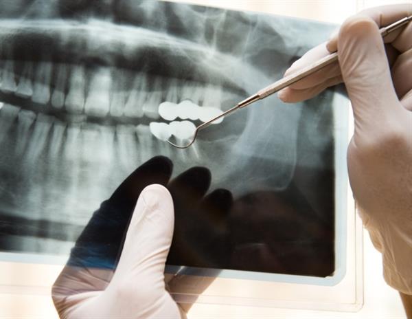 新的指导方针优先考虑安全有效的牙科x光